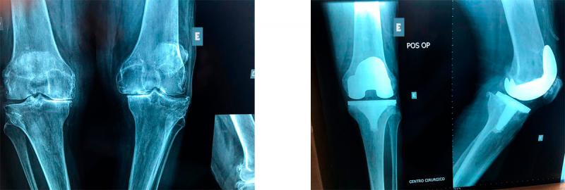 Osteoartrose do Joelho