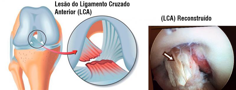 Lesões Ligamentares do Joelho